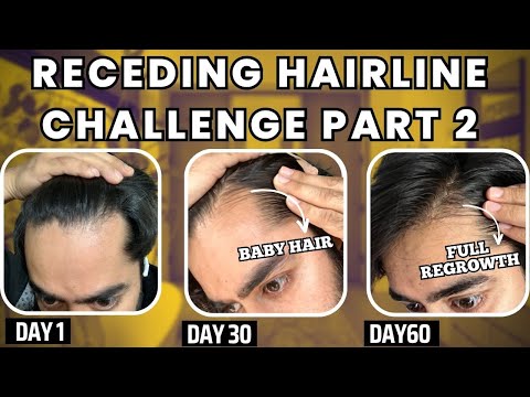 30 days HAIRLINE REGROWTH challenge PART 2 | सिर्फ 1 महीने मैं RECEDING HAIRLINE REGROW करो