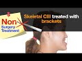Skeletal class iii with nonsurgical treatmentchris chang orthocc733