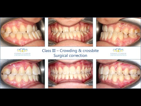 Class III malocclusion - YouTube
