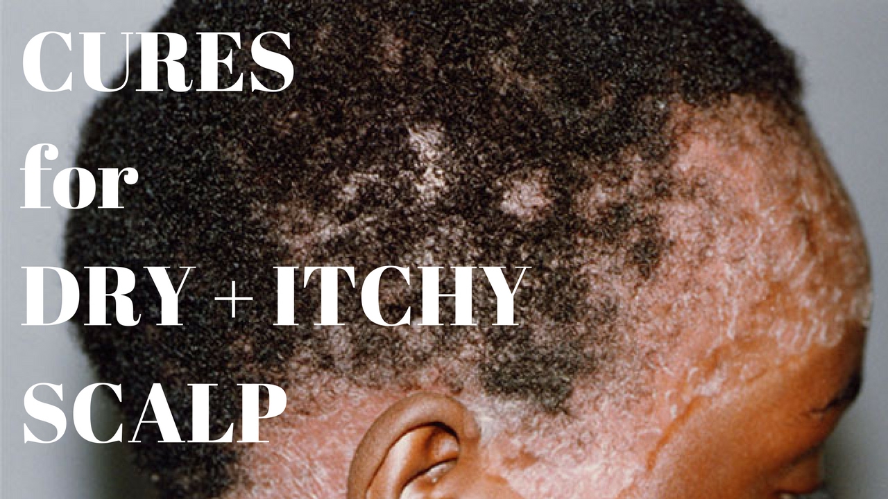 3 Cures For A Dry Itchy Scalp Natural Hair YouTube