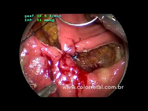 Ressecção endoscópica transanal microcirúrgica de adenoma do reto empregando sutura barbada
