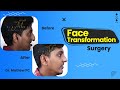 Face transformation surgery in kerala  a fresh look done with precision  before  after results