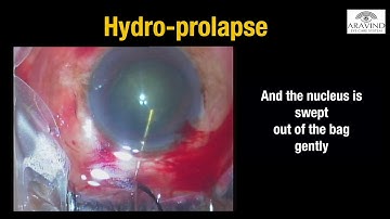 Episode 4 : Nucleus prolapse in MSICS