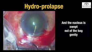 Episode 4 : Nucleus prolapse in MSICS screenshot 1