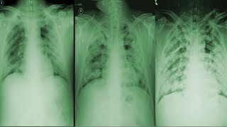 Understanding COVID-19 From Cases Described By Doctors In China screenshot 3