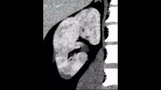 Pyelonephritis, lobar nephronia and small renal abscesses