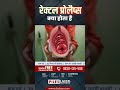 क य ह त ह र क टल प र ल प स Causes Symptoms Treatment What Is Rectal Prolapse 