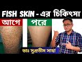 অতিরিক্ত শুকনো ও ফাটা ত্বক কিভাবে সারাবেন ? | Ichthyosis | Treatment | Dr Supratim Saha