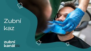 Zubní kaz - nejčastější otázky pacientů