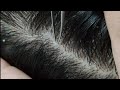 Relaxing dandruff picking 08 02sleepyheads  visual asmr to relax your mind