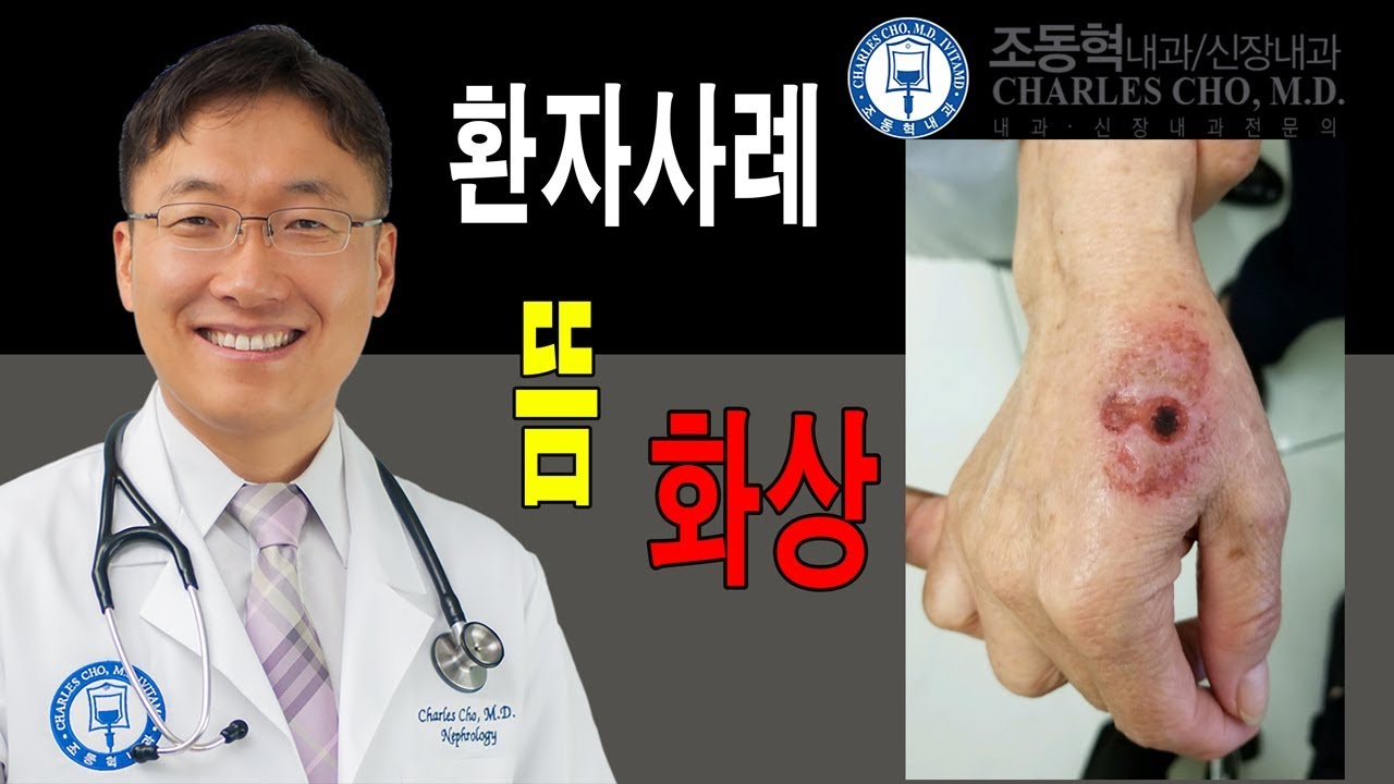 환자사례: 뜸과 화상 - YouTube