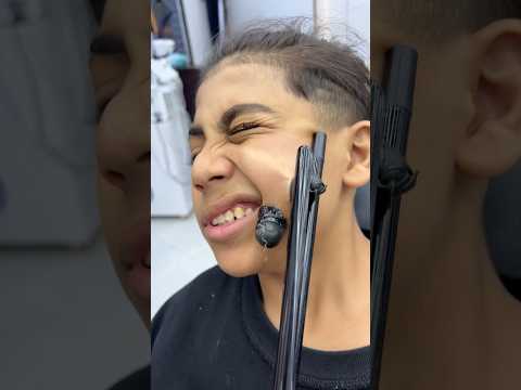 ازالة الخازوق المتسلطن من الخد       