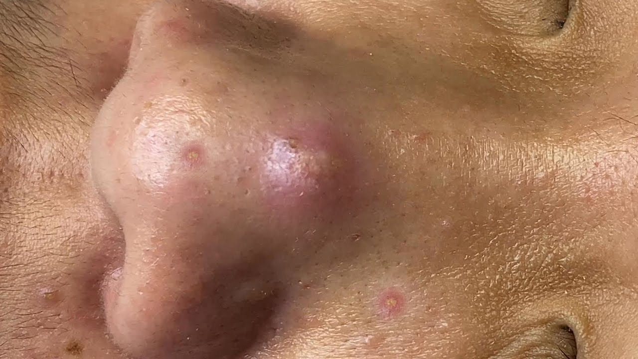 Severe acne treatment with pimple popping of Loan Nguyen