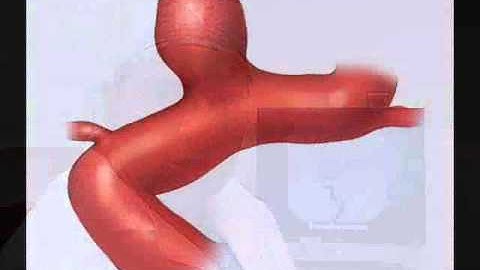 Flow Diversion for Intracranial Aneurysms - Mayo Clinic