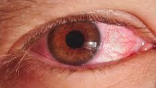 #علاج_حساسية_العين اقوى وصفة لعلاج حساسية العين بمكونين فقط مجربة ومضمونة 