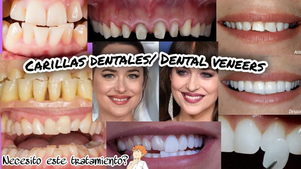 Carillas Dentales - iDental