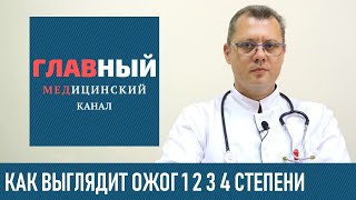 Как выглядит ОЖОГ 1 2 3 и 4 степени (фото 1-3). Классификация ожогов по глубине и степени тяжести