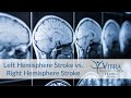 Left Hemisphere Stroke vs. Right Hemisphere Stroke | Vibra Rehabilitation Hospital of Amarillo