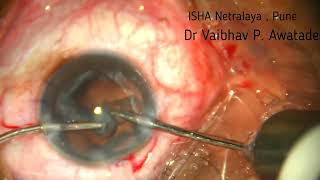 Phaco in Soft Cataract , Trio Toric IOL , 23/05/26