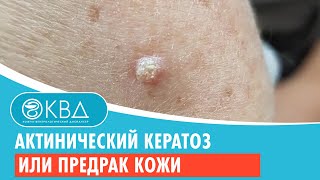 😲 Актинический кератоз или предрак кожи. Клинический случай №750