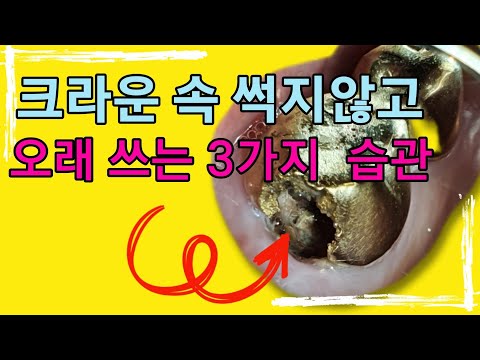   크라운 치료한 치아 오래 쓰는 3가지 습관