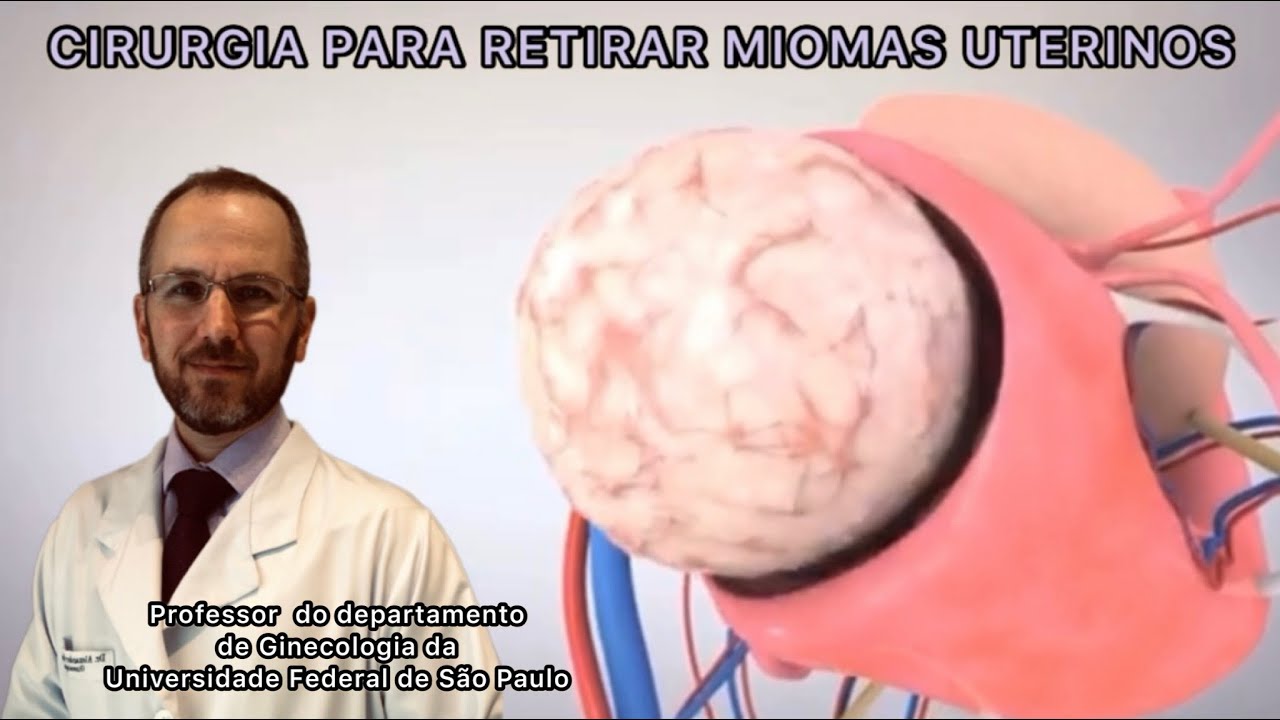 MIOMECTOMIA - CIRURGIA PARA RETIRAR MIOMAS DO ÚTERO