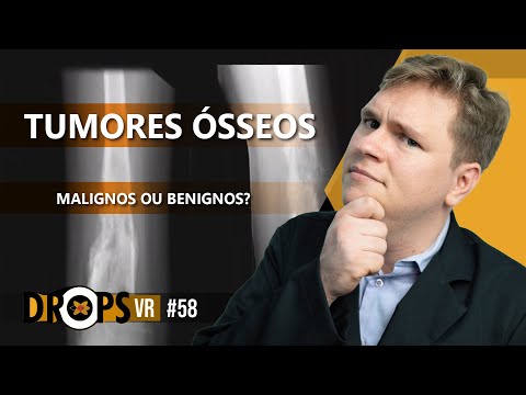 Vídeo: Os tumores de câncer ósseo são duros ou moles?