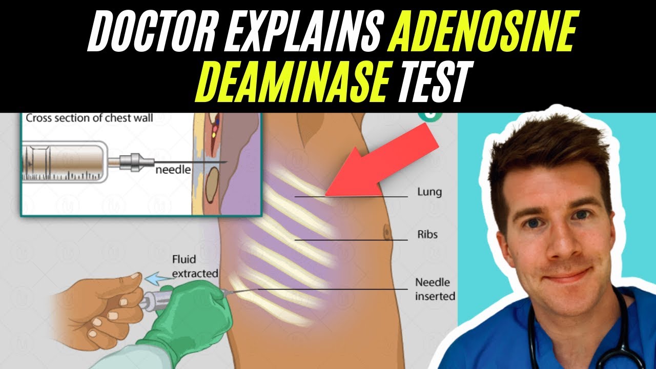 Doctor explains Adenosine Deaminase test | Tuberculosis (TB) - YouTube