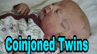 SPECIAL Box Opening! Two Faced Baby! Twin Baby Girls Born With Two Faces One Body!