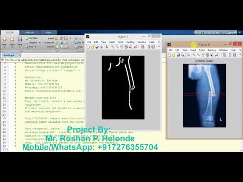 Bone Fracture Detection Using Image Processing Matlab Project With source Code