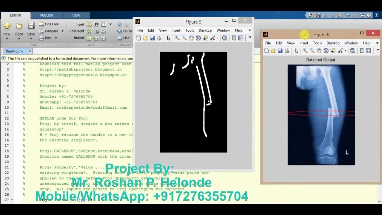 Bone fracture detection using image processing matlab project with