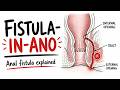 Anal Fistula (Fistula-in-Ano): Causes, Symptoms, Anatomy, and Treatment