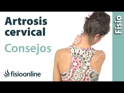 Vídeo: Artrosis Uncovertebral: Tratamiento, Artrosis De La Columna Cervical
