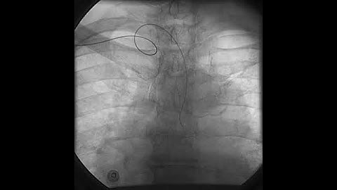 Transradial  Access - Video 5.5