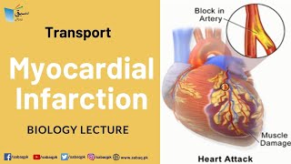 Myocardial Infarction, Biology Lecture | Sabaq.pk |