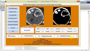 Brain Tumor Detection and Classification Using Matlab Project Code