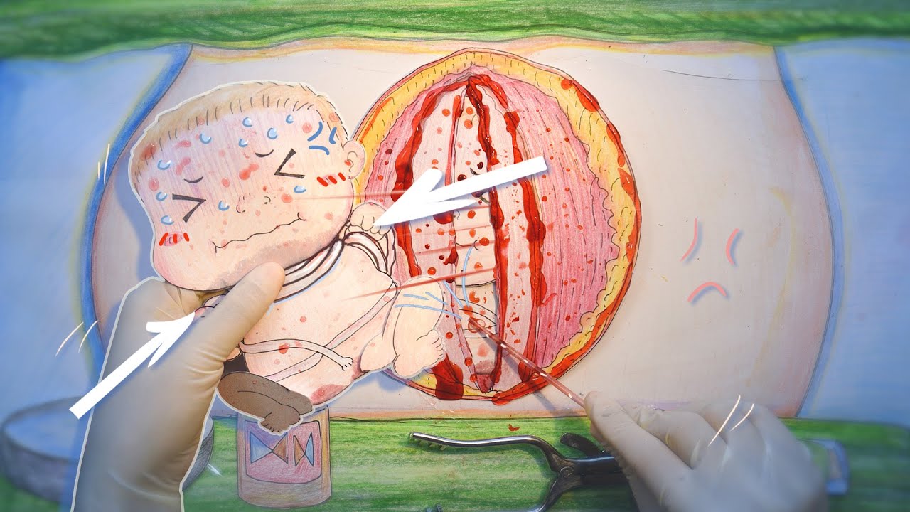 宝宝在妈妈的肚子里用脐带绕颈差点窒息！