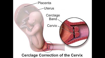CPT codes for Removal - simplify medical coding