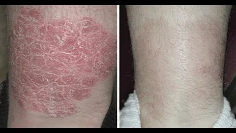 “牛皮癣”怎么救？“10种天然疗法”对症下药：加速皮肤愈合、平衡免疫力，重回“不痛不痒”的人生！ - 天天要闻
