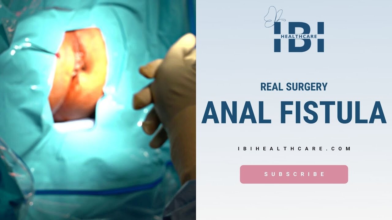 First Case In The Us Video Assisted Anal Fistula Treatment Vaaft Anal Fistula Surgery