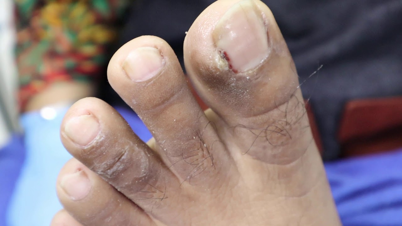 Ep_774 Ingrown toenail removal ������ ยังไม่ทันตัด..เลือดออกแล้วหนอ ������ (This video clip from Thailand