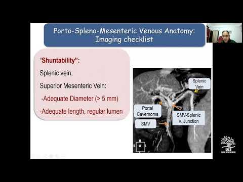 Extrahepatic Portal Vein Obstruction (EHPVO): Dr. Richa Lal