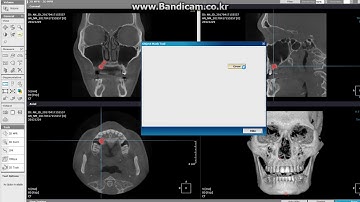 Impacted tooth Segmentation OnDemand3D