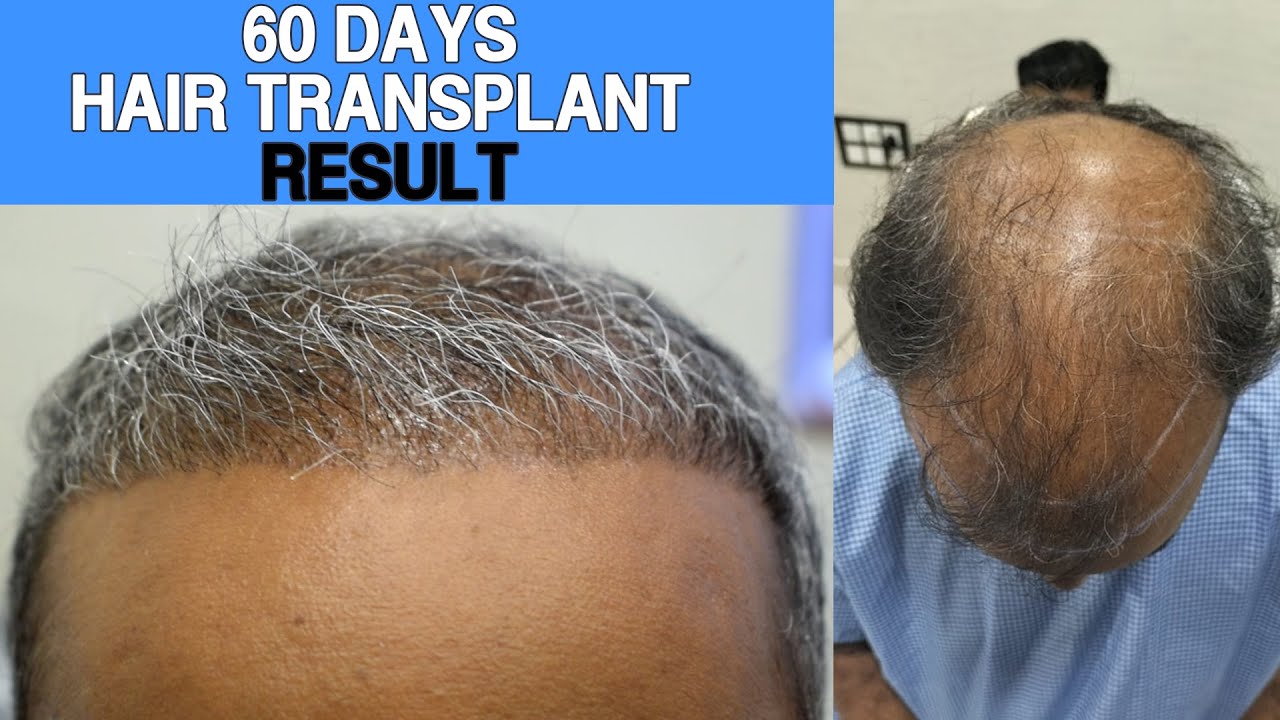 Hair transplant 60 days result & review Unique Hair grow Chennai