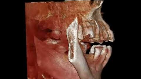 Prexion3D CBCT Bony Defect Video