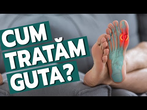 Video: 3 moduri de a diagnostica și trata scorbut