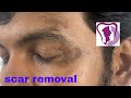 Giant Multiple Scars around the eyes n cheek removed by plastic surgery