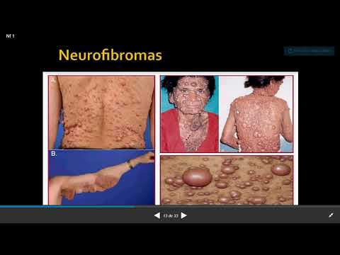 Vídeo: Neurofibromas Cutáneos En La Neurofibromatosis Tipo I: Un Estudio Cuantitativo De Historia Natural