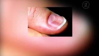 видео Волнистые ногти на руках: причины и лечение