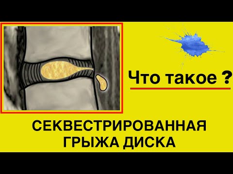 Что такое секвестрированная